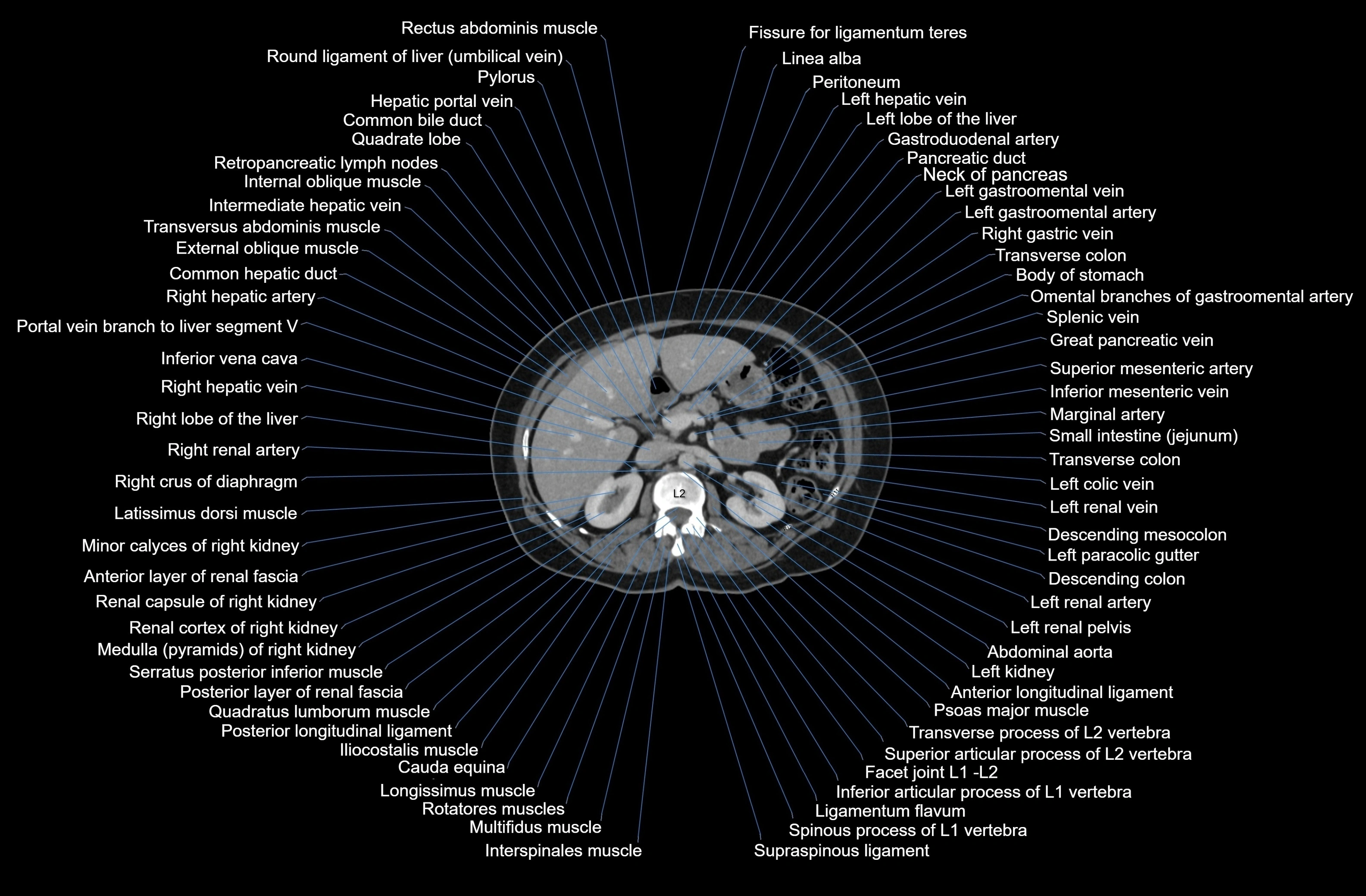 CT Abdomen axial cross sectional anatomy labelled radiology image-00031.webp
